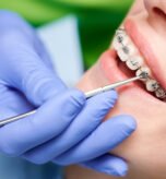 Close up of dentist hand using dental forceps while putting orthodontic braces on female patient teeth. Woman having dental procedure in clinic. Concept of dentistry and orthodontic treatment.