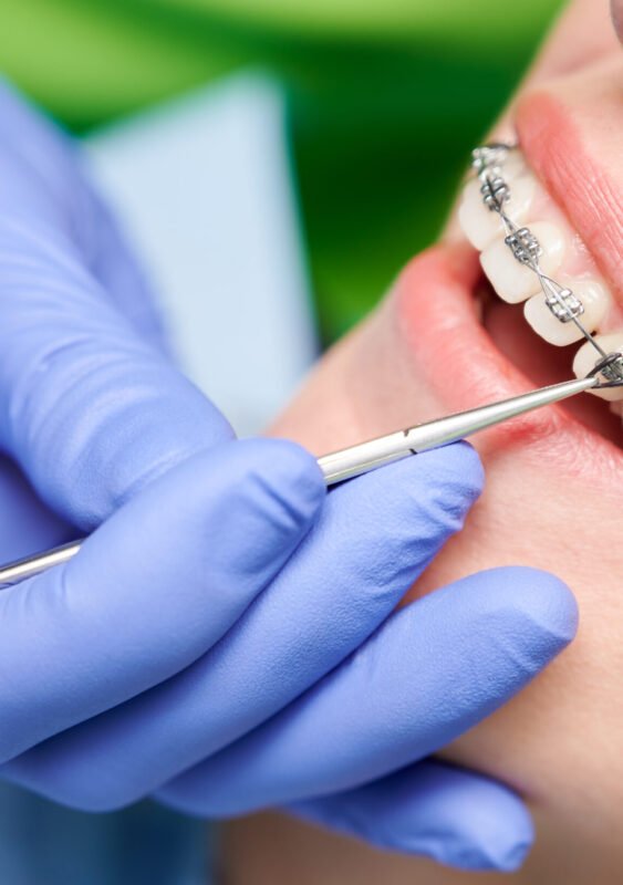 Close up of dentist hand using dental forceps while putting orthodontic braces on female patient teeth. Woman having dental procedure in clinic. Concept of dentistry and orthodontic treatment.