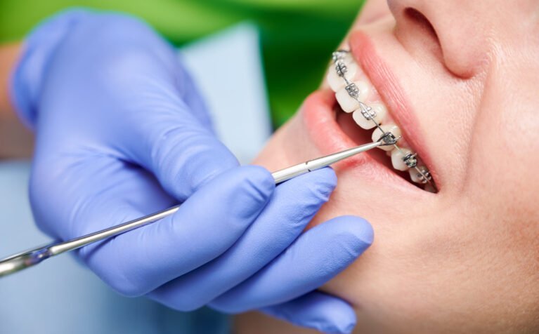 Close up of dentist hand using dental forceps while putting orthodontic braces on female patient teeth. Woman having dental procedure in clinic. Concept of dentistry and orthodontic treatment.